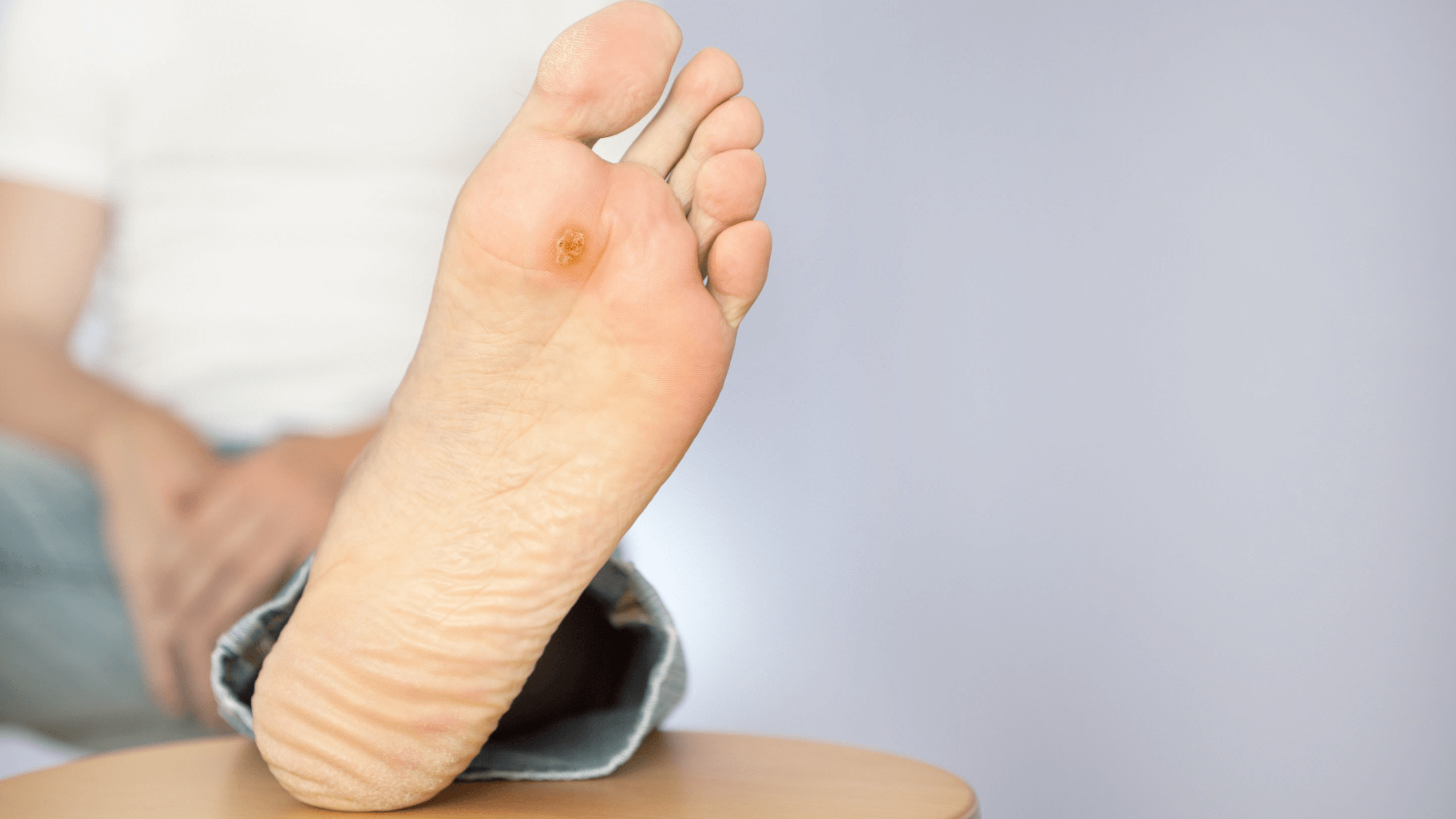 Foot Calluses: Prevention and Treatment Tips - Feet First Clinic